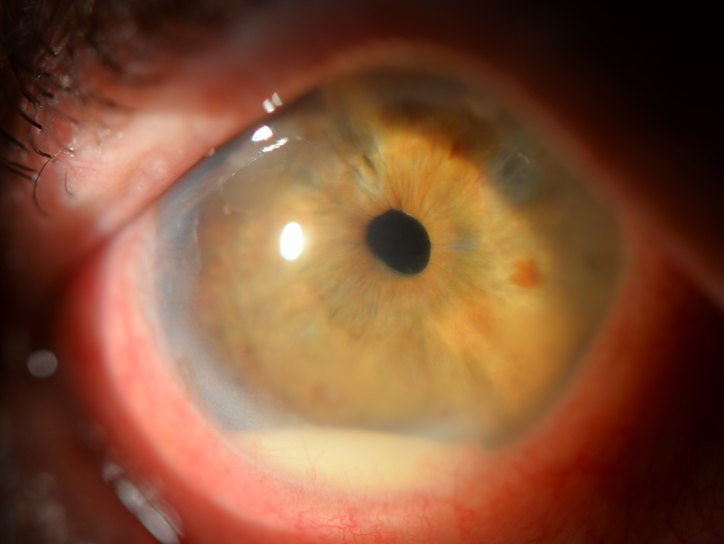 Иридоциклит глаза:симпотомы - "Здоровое око"