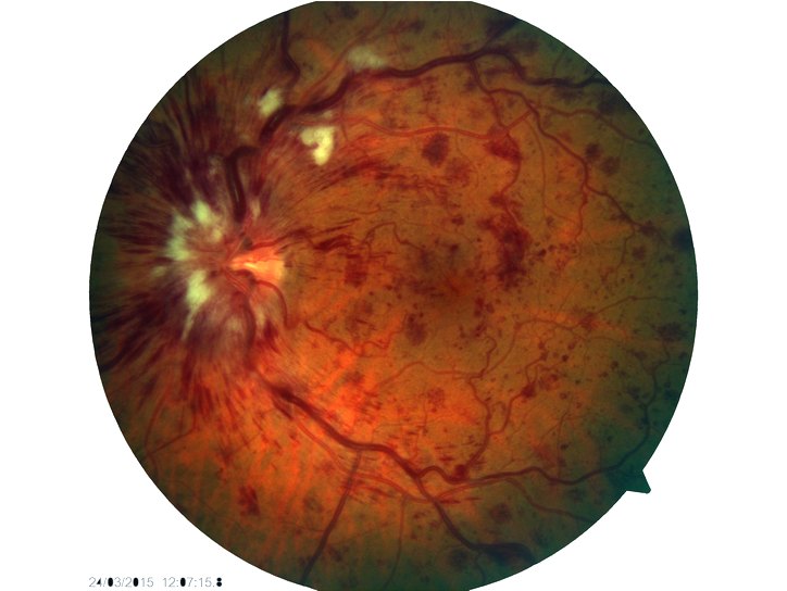 Тромбоз центральной вены сетчатки глаза – симптомы и лечение тромбоза ЦВС