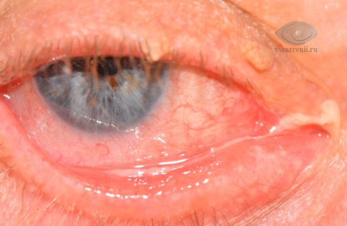 Каналикулит - боль в уголке глаза
