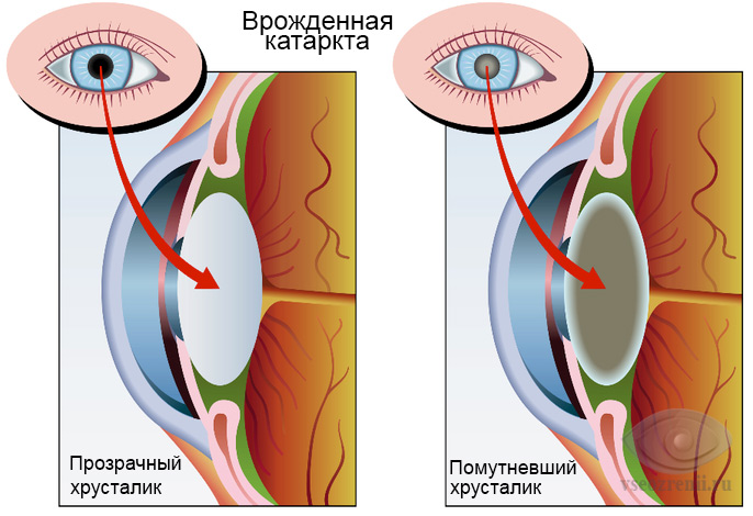 врожденная катаракта