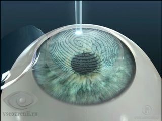 лазерная коррекция зрения