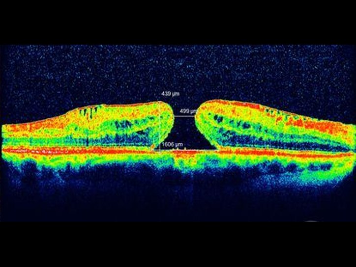 Макулярный разрыв