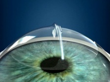 Epi-LASIK: возвращение лоскута роговицы на место