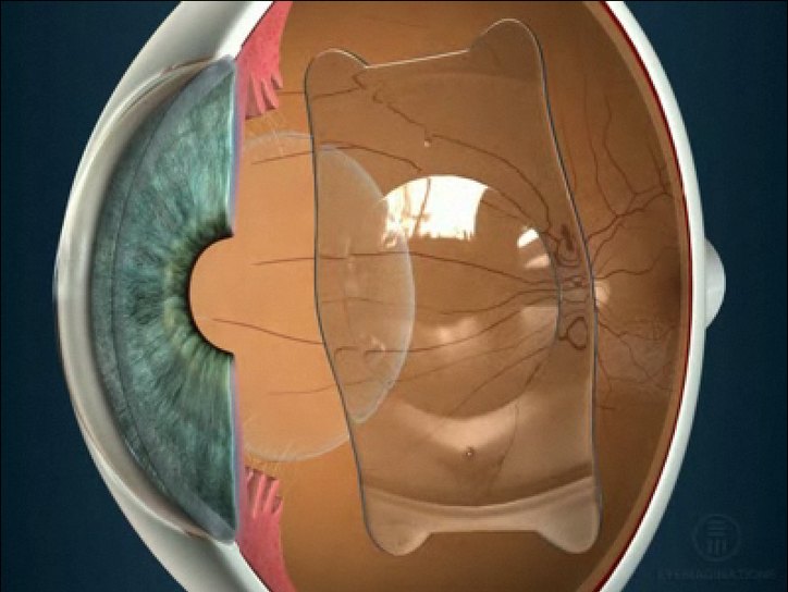 Факичные имплантируемые линзы
