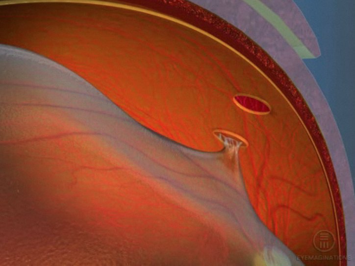 Стекловидное тело операция. Разрыв сетчатки (retinal tear). Макулярный разрыв сетчатки глаза. Периферическая дегенерация сетчатки глаза.