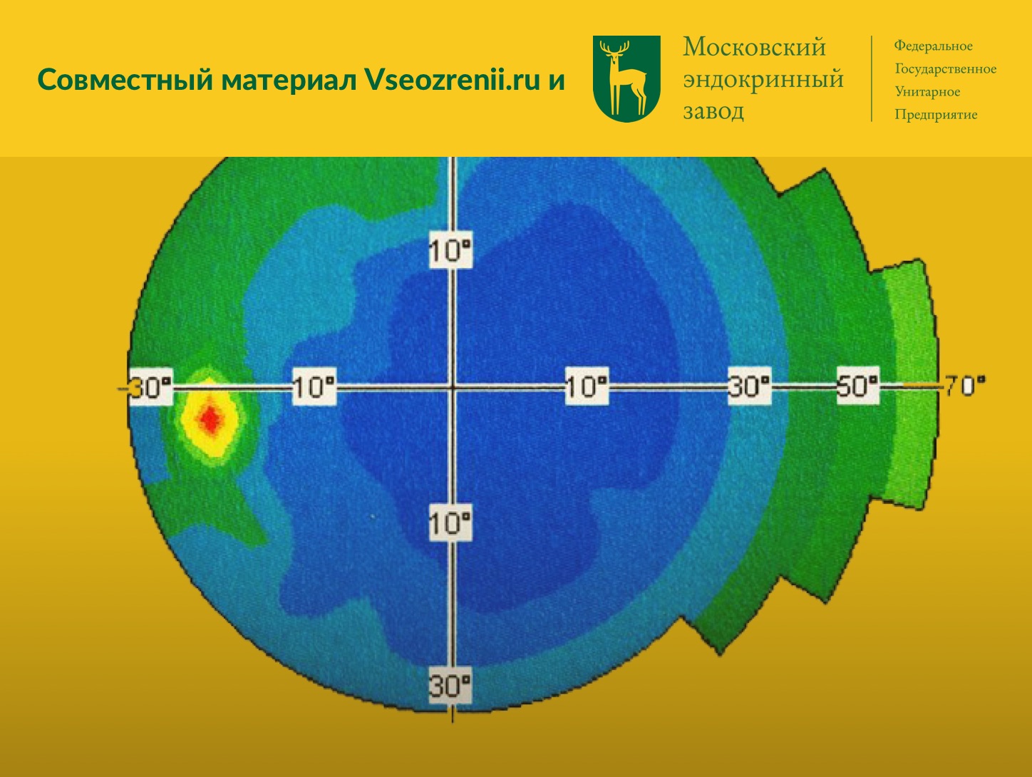 Врожденная глаукома