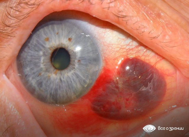 Кровоизлияния в глазу диагностируют и лечат в отделении офтальмологии в медицинском центре Клиника К 31. Консультация врача круглосуточно.