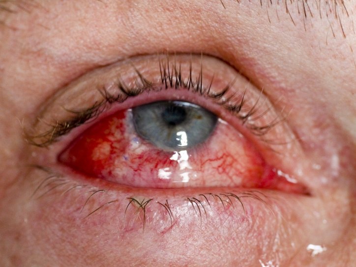 Проникающая травма глаза