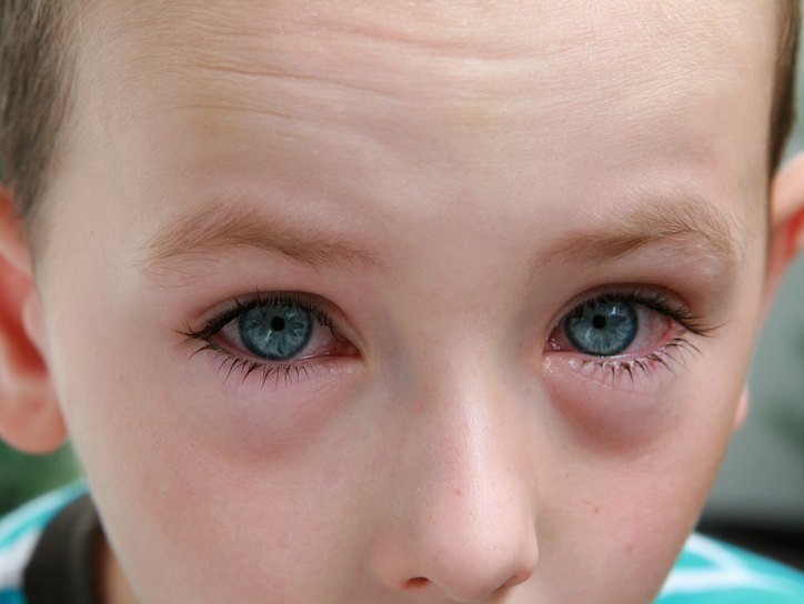 Аллергия глаза
