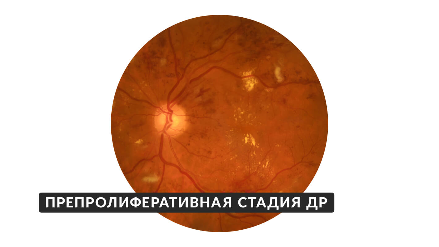 preproliferativnaya-diabeticheskaya-retinopatiya-1.jpg