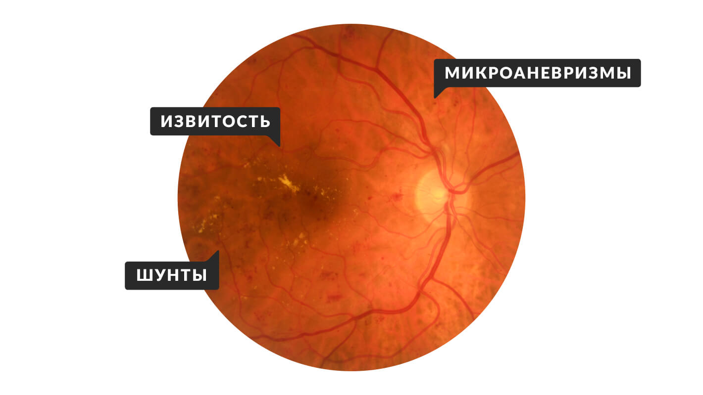 izmeneniya-sosudov-pri-diabete-2.jpg