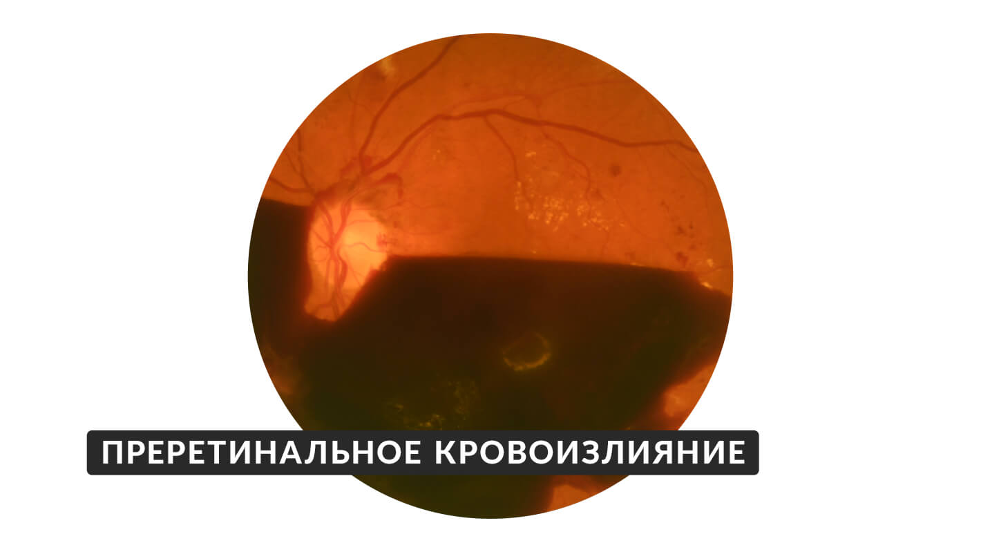 preretinalnoe-krovoizliyanie-11.jpg