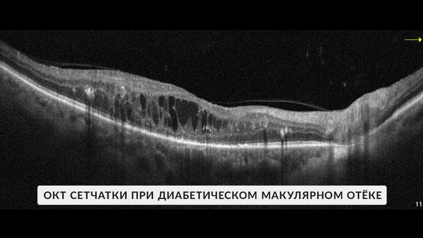 okt-diabeticheskij-makulyarnyj-otek-1.jpg