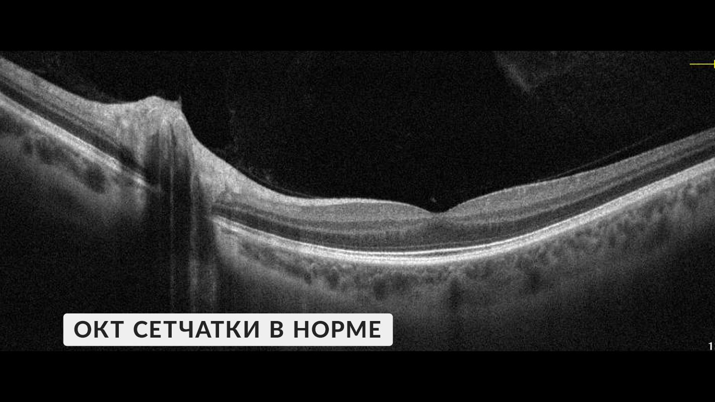 okt-setchatka-v-norme-2.jpg