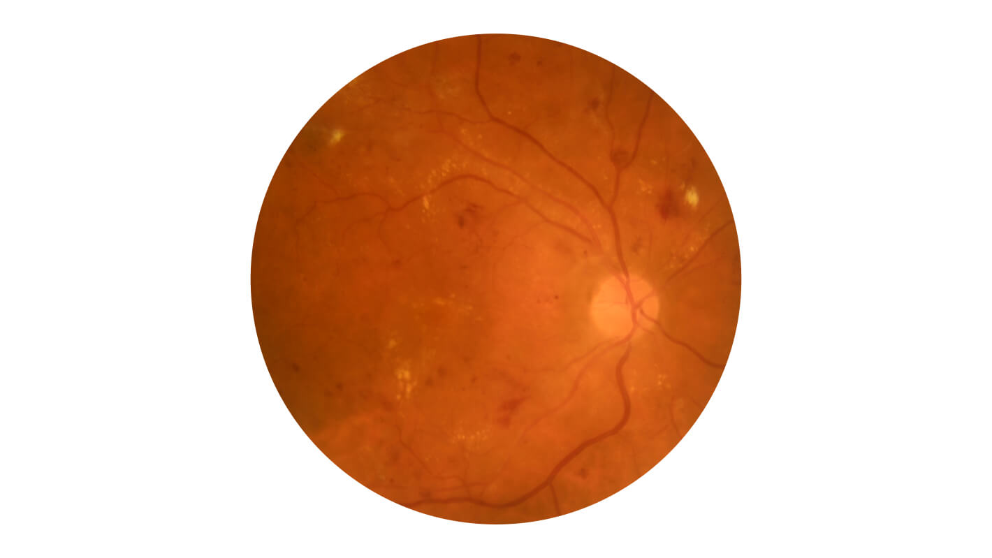 diabeticheskaya-retinopatiya-v-dinamike-do-7.jpg