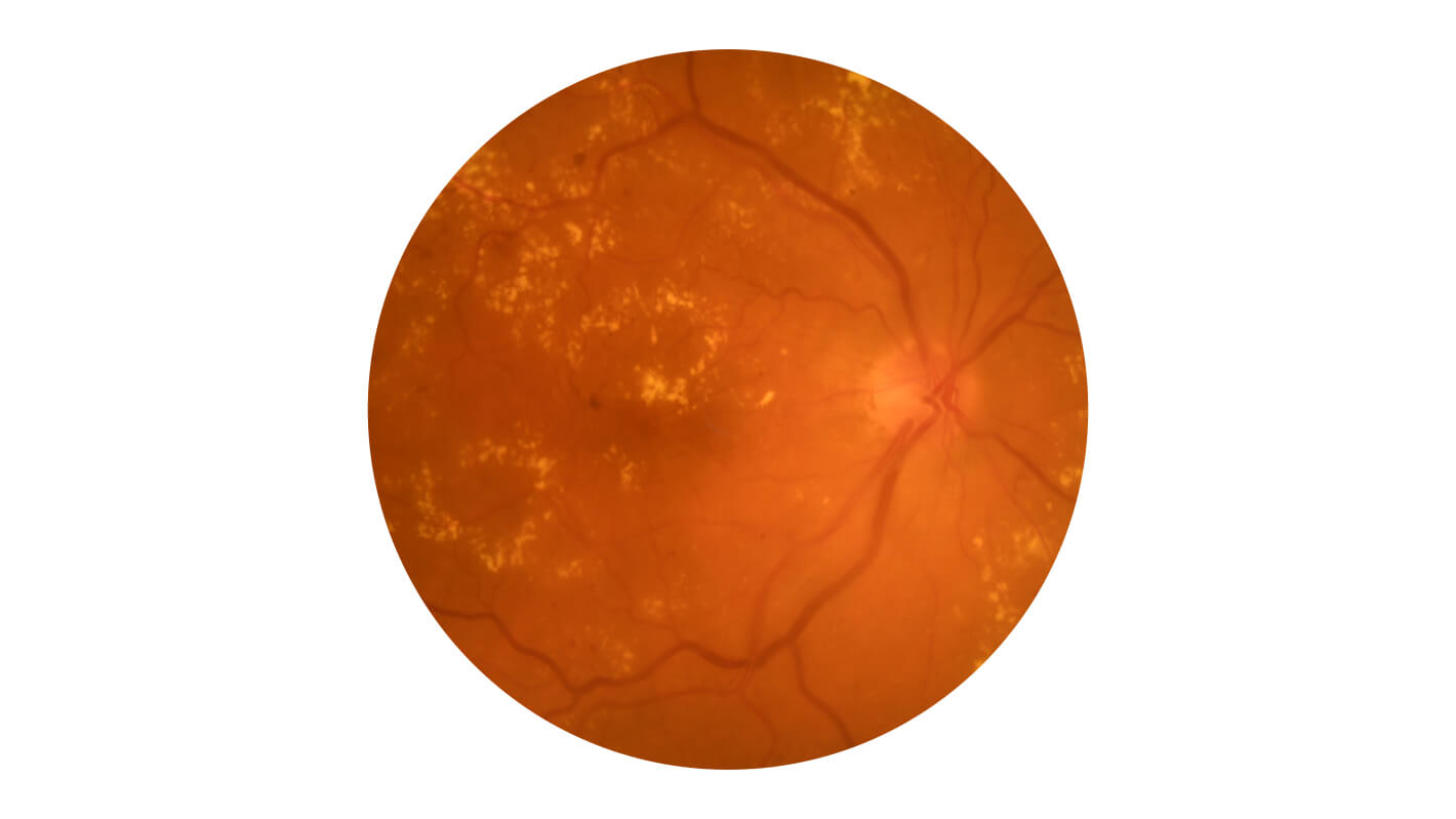 diabeticheskaya-retinopatiya-v-dinamike-posle-8.jpg