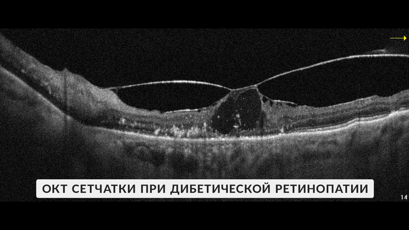 okt-vyrazhennaya-diabeticheskaya-retinopatiya-6.jpg