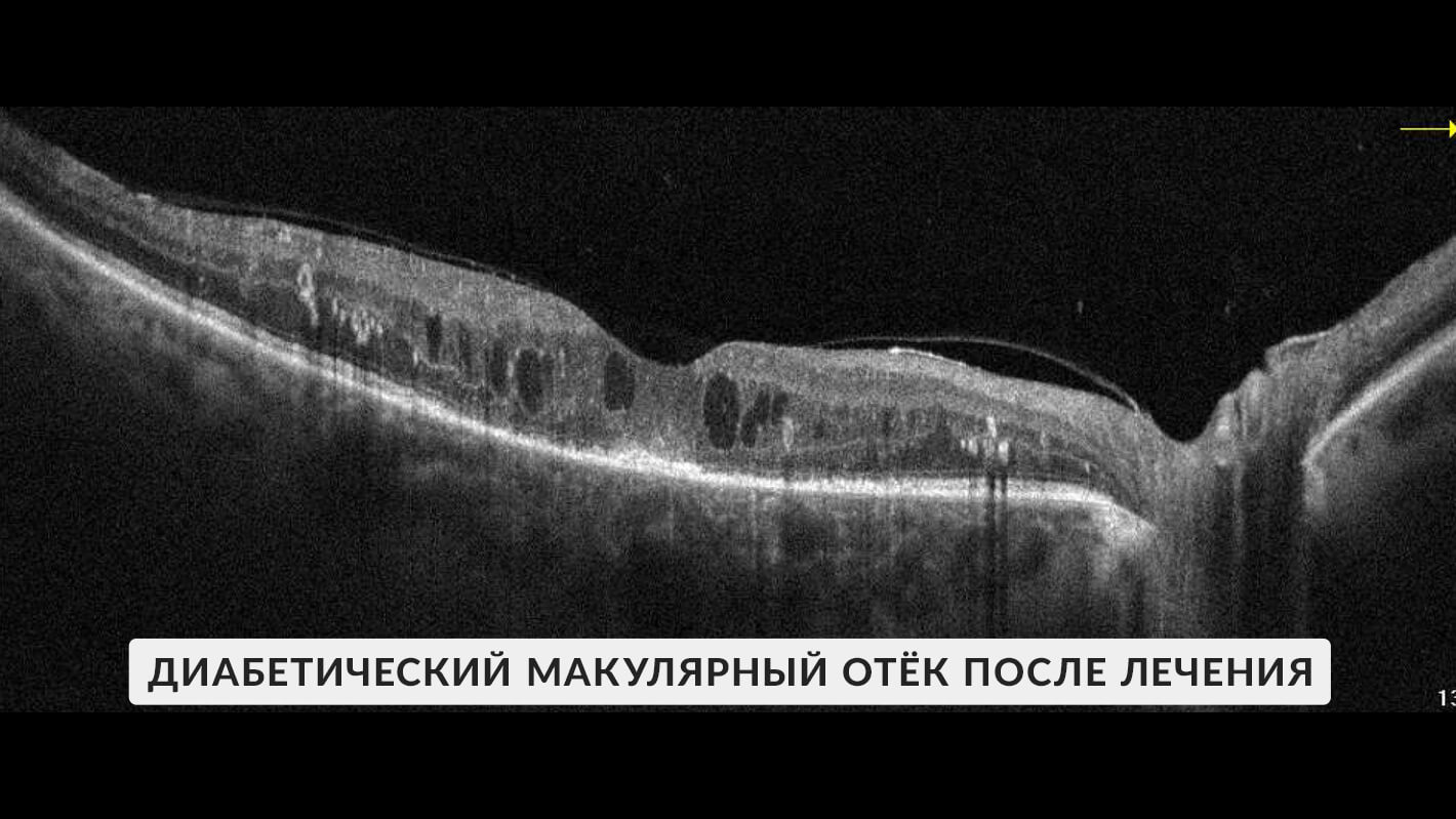 okt-diabeticheskij-makulyarnyj-otek-posle-ivv-5.jpg