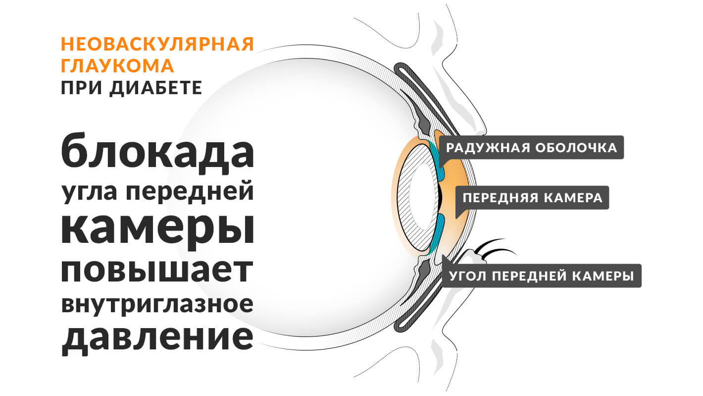 neovaskulyarnaya-glaukoma-pri-saharnom-diabete-2.jpg