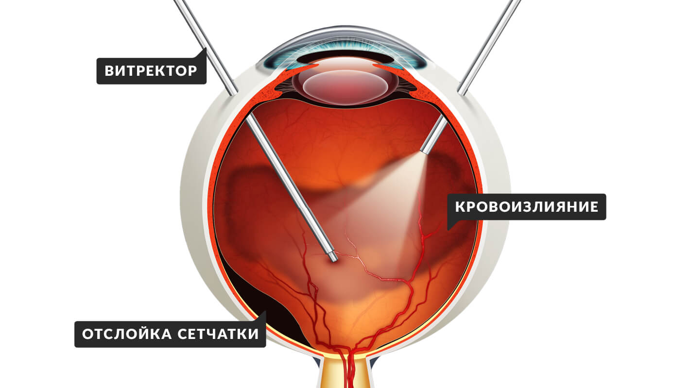 operaciya-vitrehktomiya-pri-diabeticheskoj-retinopatii-1.jpg