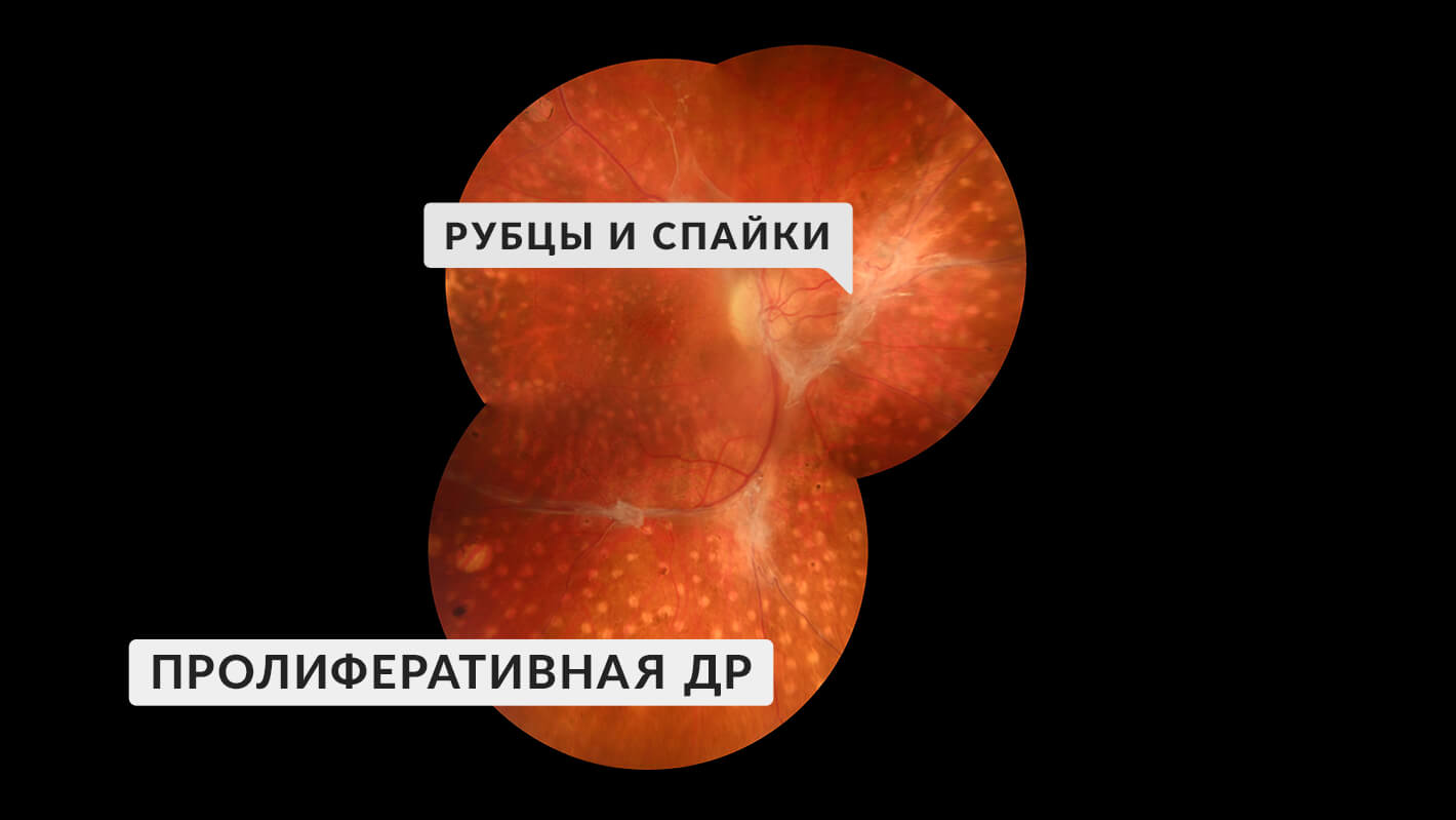 proliferativnaya-diabeticheskaya-retinopatiya-3.jpg
