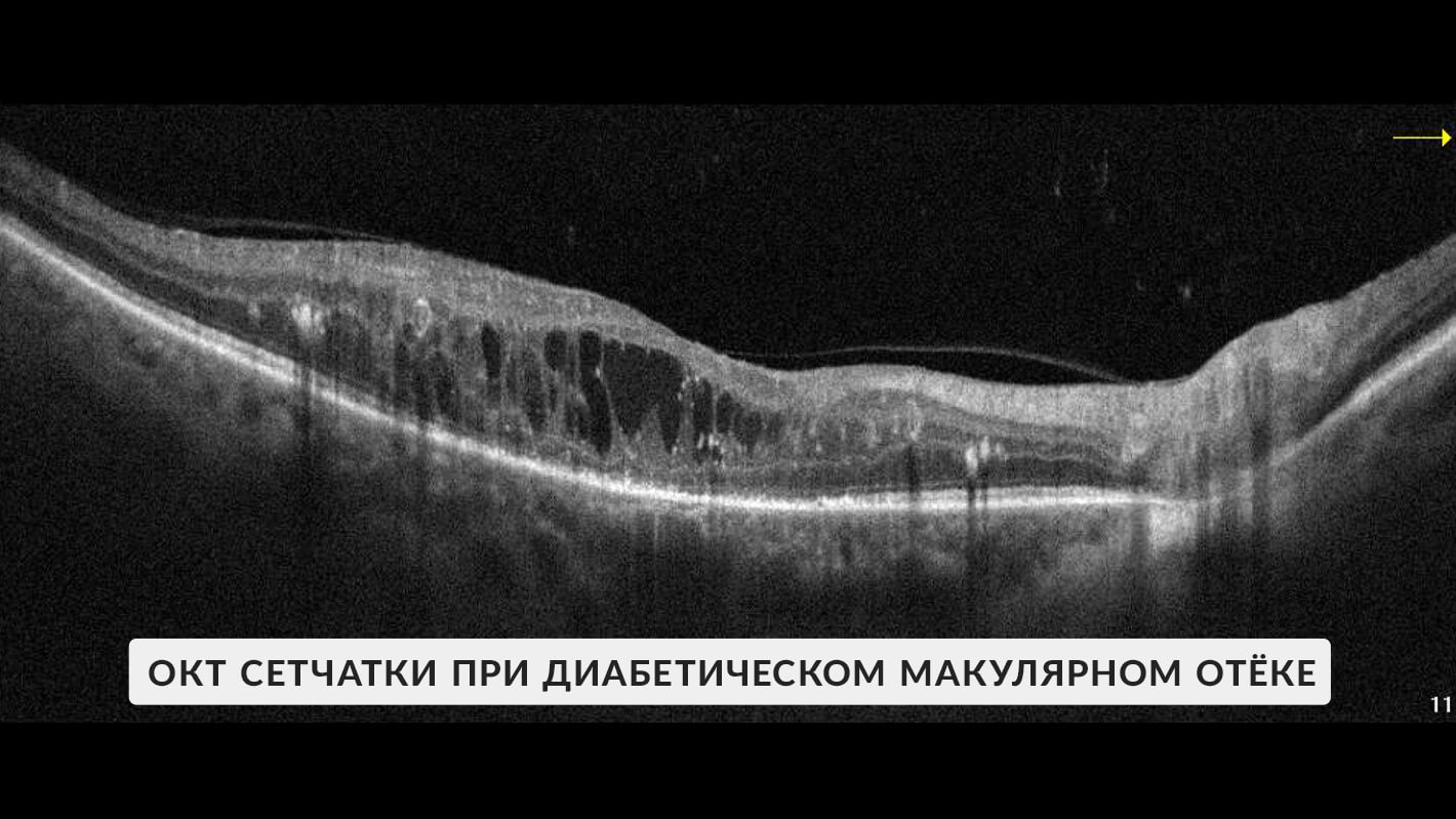 okt-diabeticheskij-makulyarnyj-otek-do-ivv-2.jpg