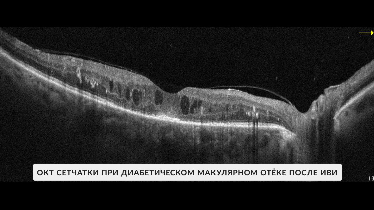 okt-diabeticheskij-makulyarnyj-otek-posle-ivv-3.jpg