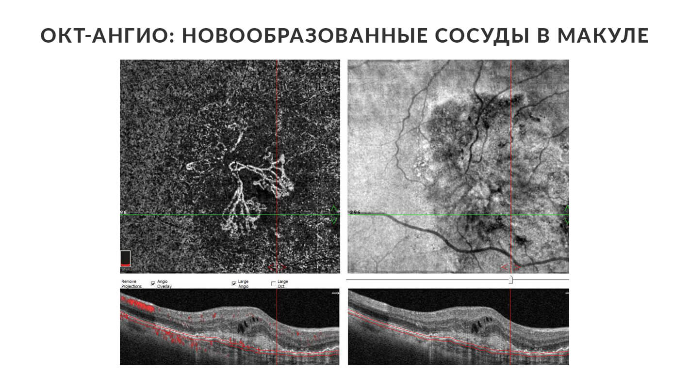 okt-angio-vlazhnoj-vmd-5.jpg