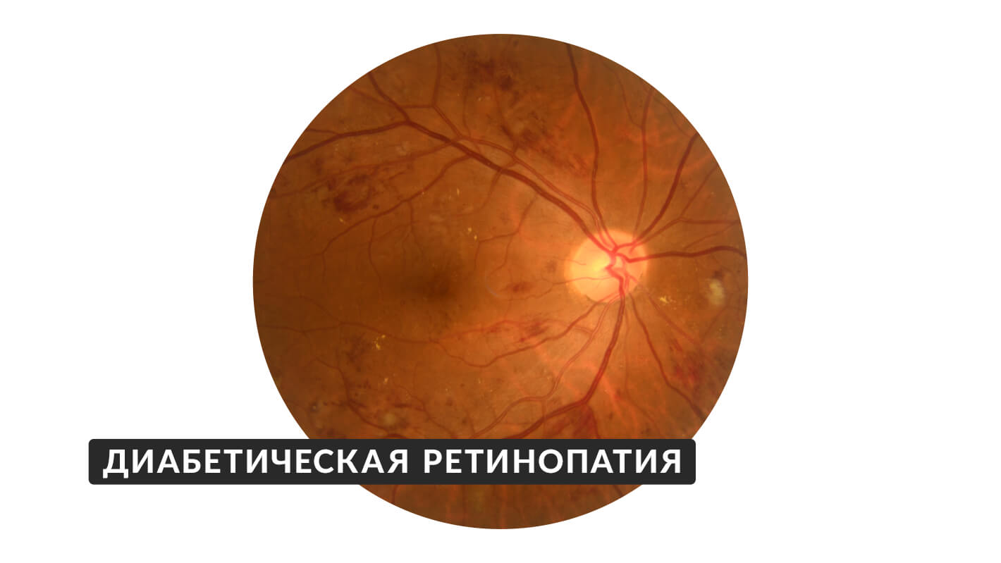 diabeticheskaya-retinopatiya-10.jpg