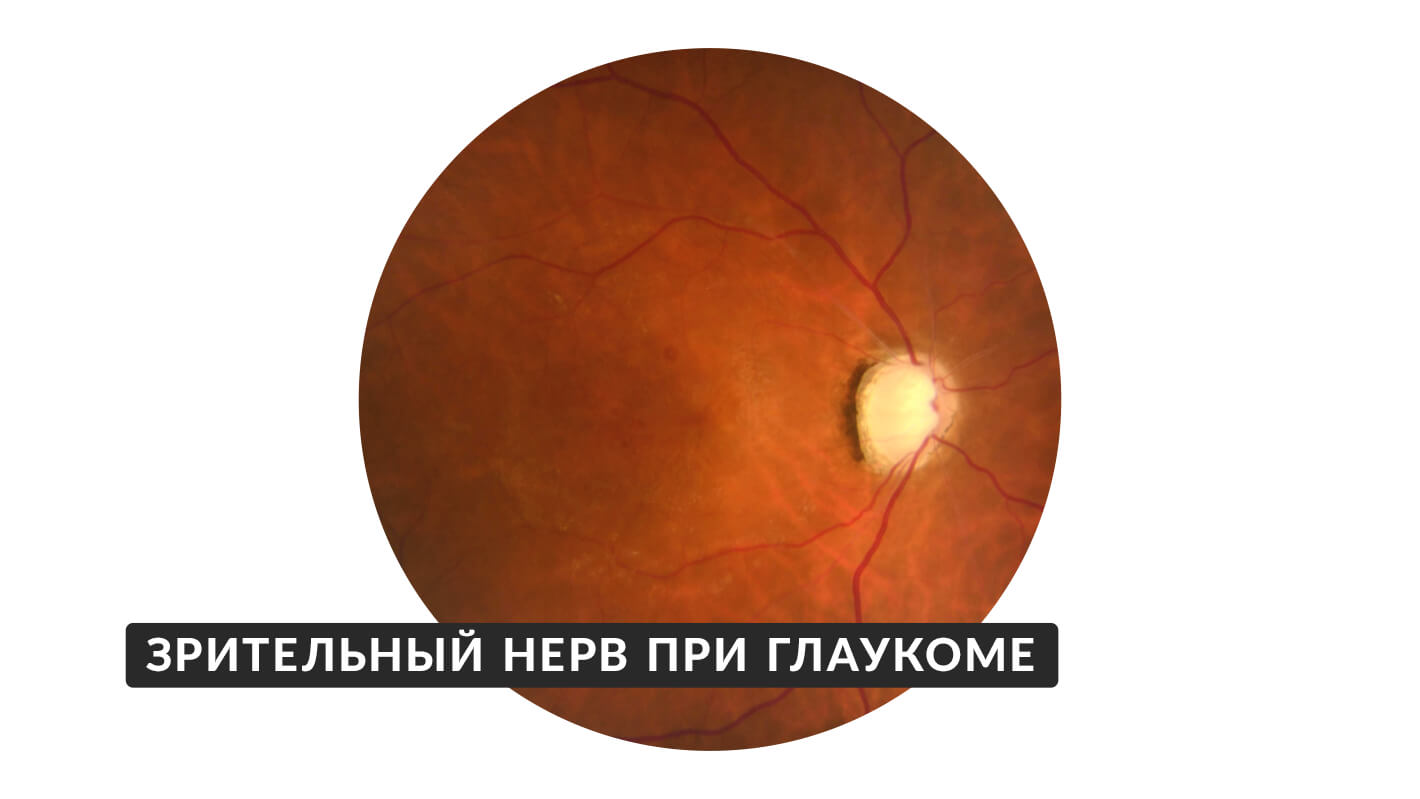 glaukoma-16.jpg