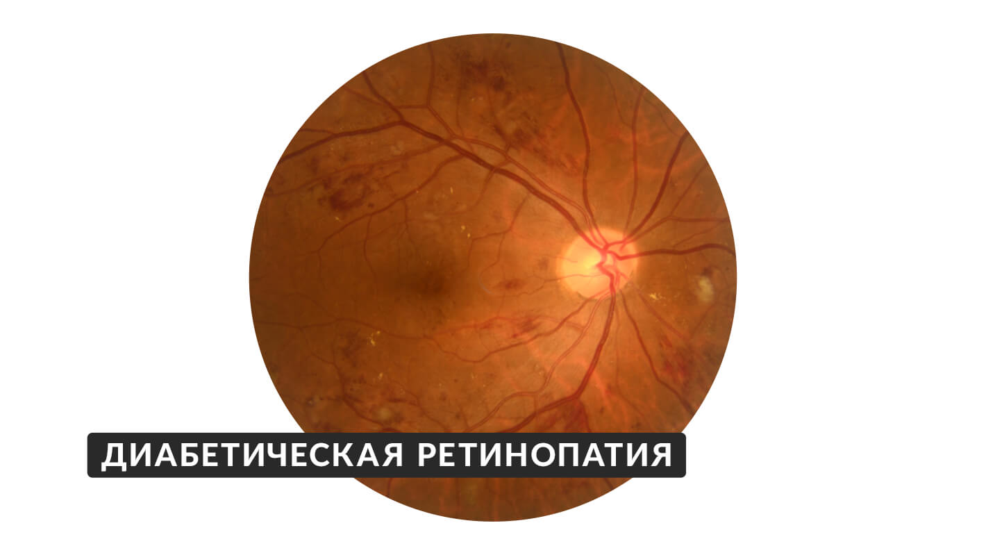 diabeticheskaya-retinopatiya-6.jpg
