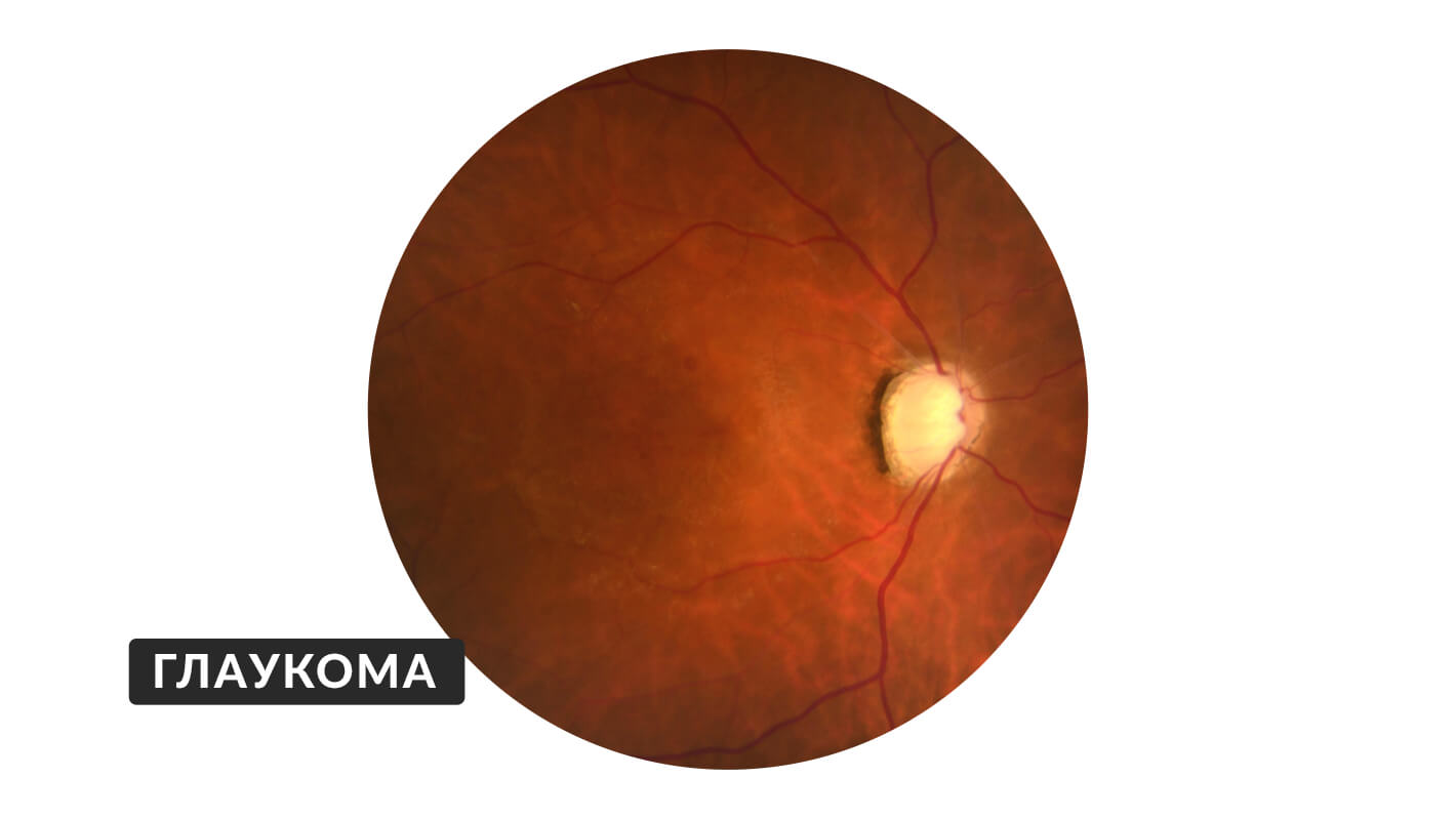 glaukoma-10.jpg