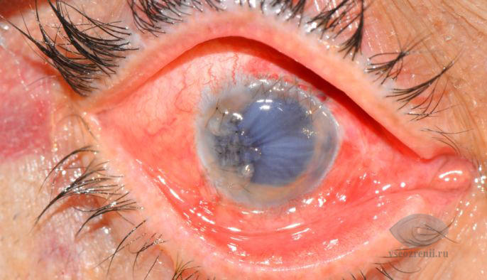 восстановление анатомической целосности глаза