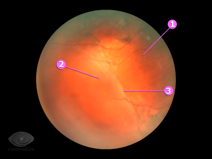 отслойка сетчатки