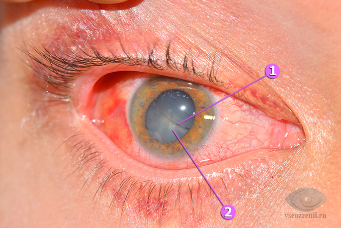 травма глаза травматическая катаракта 