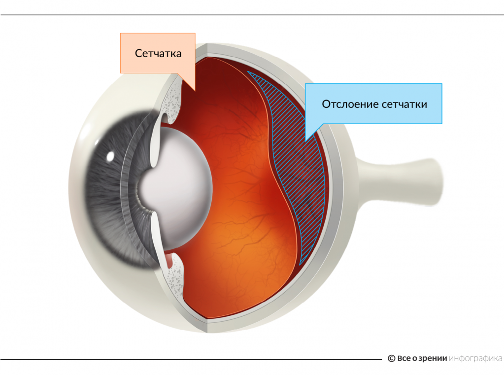 отслойка сетчатки