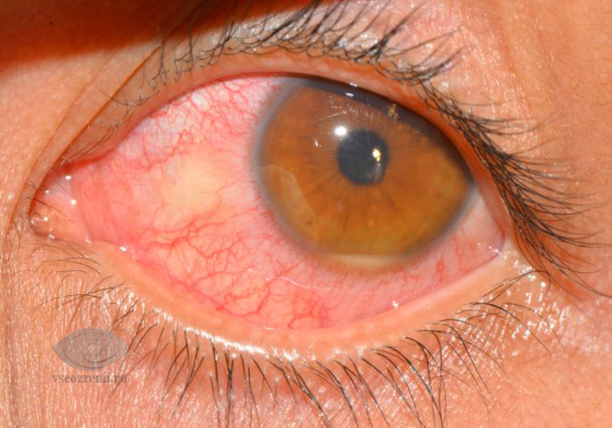 иридоциклит - боль в глазах