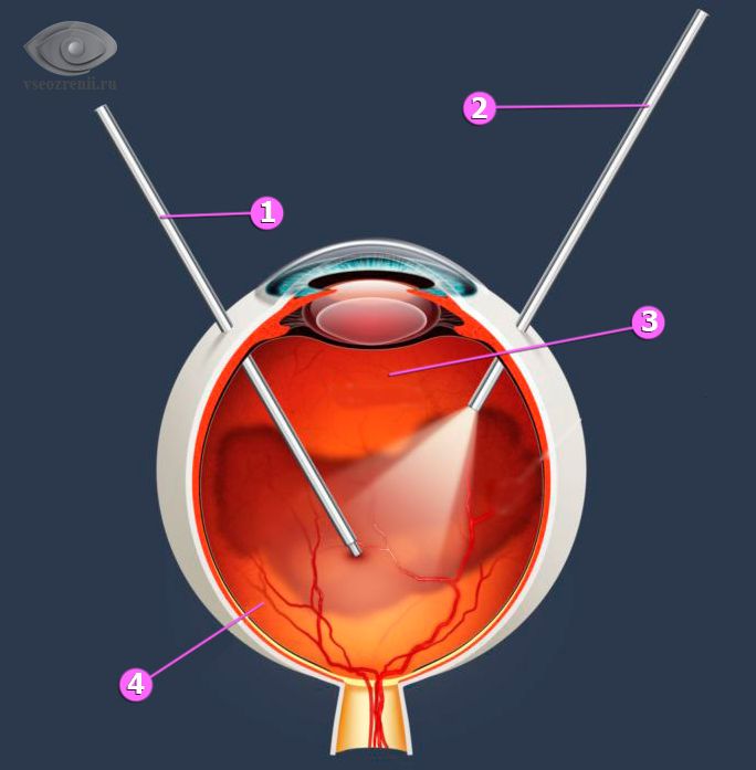 Схематическое изображение витрэктомии