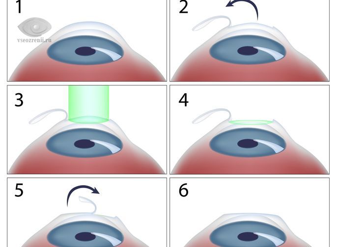 lasik-i-sport.jpg lasik-i-sport.jpg