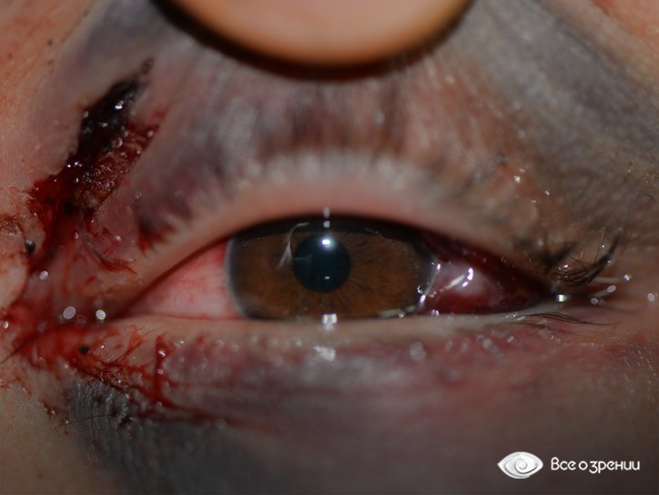 обширное кровоизлияние в глаз и веки после травмы
