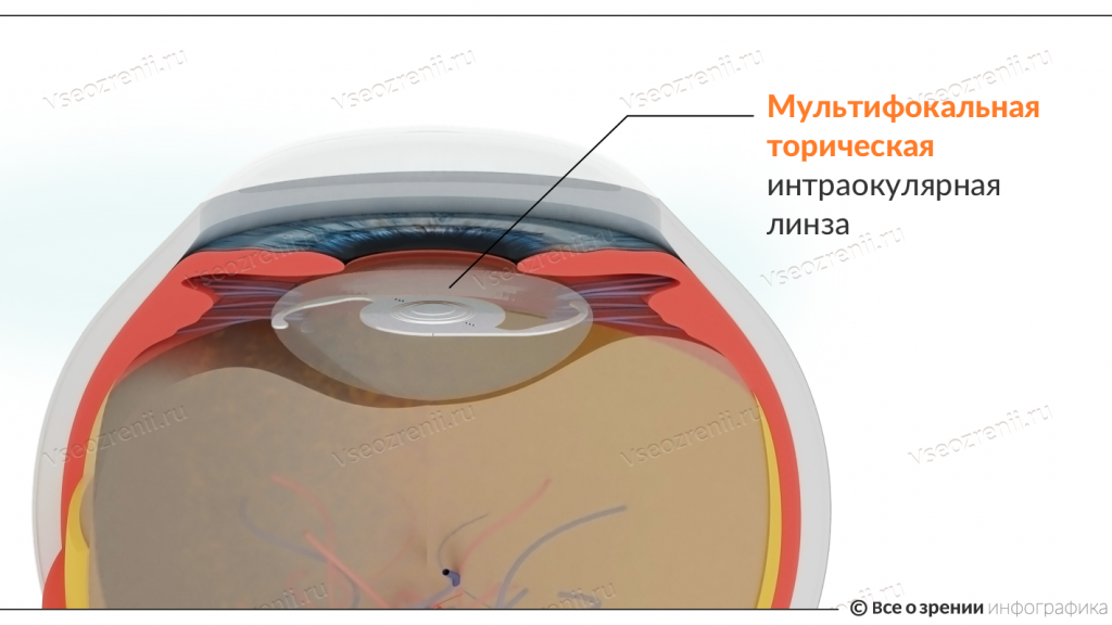 multifokalnaya-toricheskaya-iol.png