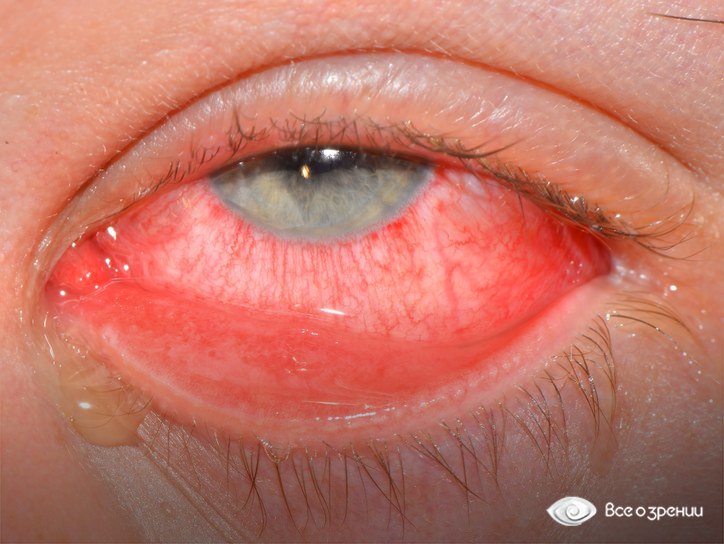 воспаления глаза с кровоизлияниями