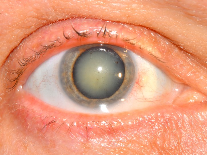 современные средства лечения гипертонии катаракты
