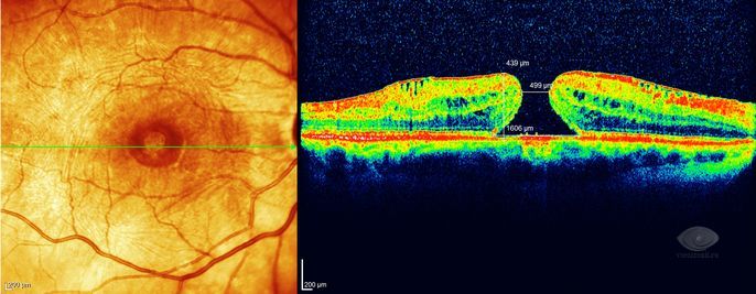 Макулярный разрыв после операции