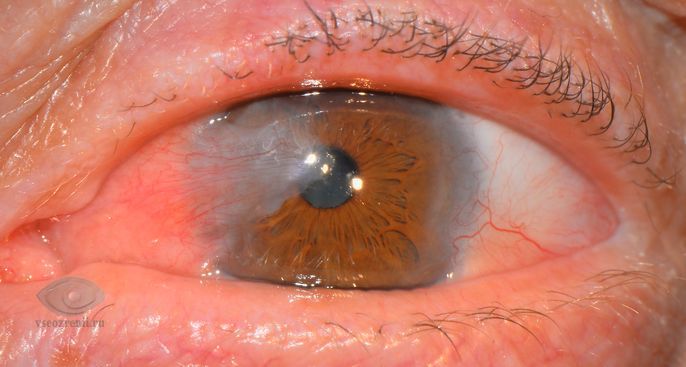 pterigium.jpg