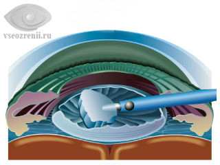 Способы лечения катаракты глаза факоэмульсификация thumbnail