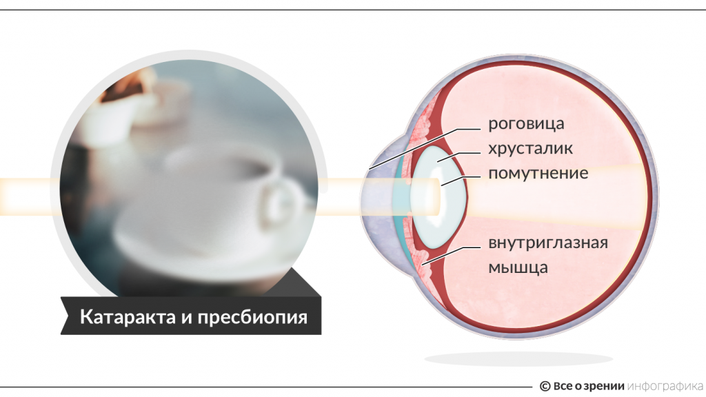 Что нельзя после операции катаракты глаза. Мультифокальные ИОЛ катаракта. Искусственный хрусталик глаза. Интраокулярные линзы. Интраокулярные линзы при катаракте.