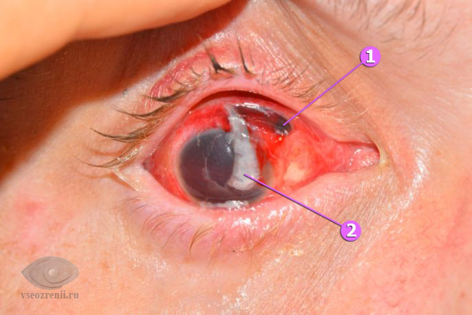 разрыв глаза при травме