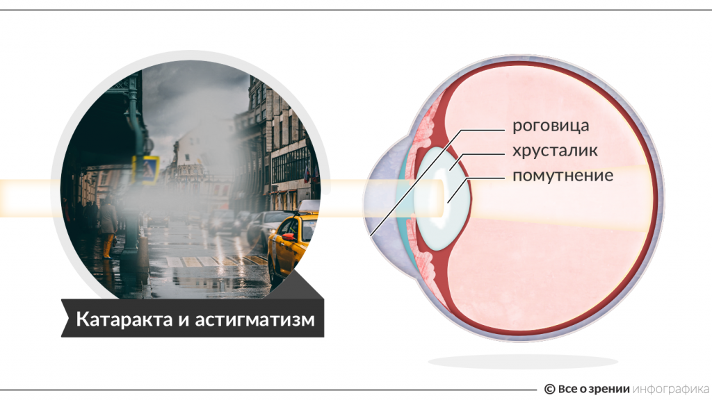 katarakta-i-astigmatizm1.png