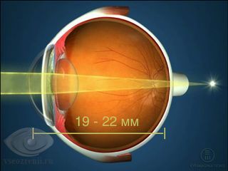 размер глаза при гиперметропии